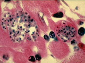 Imagen A: Microfotografía de amastigotes de Trypanosoma cruzi en el músculo cardiaco de un paciente con enfermedad de Chagas (Fotografía cortesía de los Centros para el Control y Prevención de Enfermedades de los EUA).